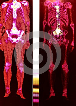 Urothelial cancer metastasis spinal vertebraes pelvis