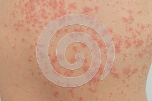 Urticaria is an allergic reaction on the skin. Red spots on the skin