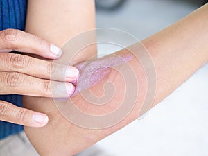 Urticaria on hand woman non-lethal type from food and air poisoning. she apply Calamine Lotion medicine on the arm her.she Sick,