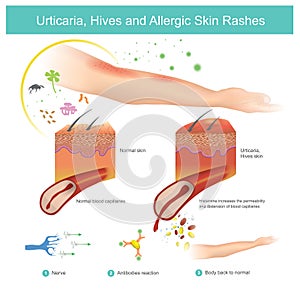 Urticaria, Hives and Allergic Skin Rashes. Illustration.