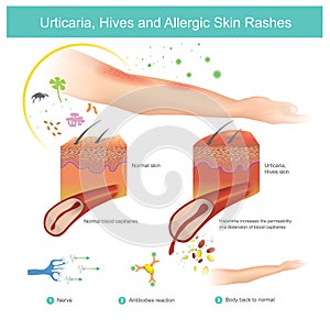 Urticaria, Hives and Allergic Skin Rashes. Illustration. photo