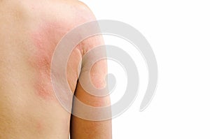 Urticaria - isolated on white background with clipping path. photo