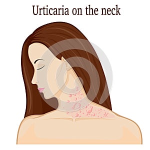 Urticaria on the neck photo