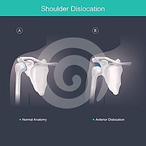 This is use for explain and compare when the head of the humerus is out of the shoulder joint include shoulder pain. Anatomy body