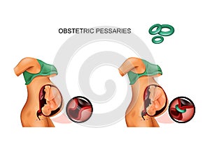 Use of obstetric pessarium in the opening of the cervix of the pregnant uterus photo