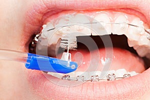 Using an interdental brush for orthodontic braces