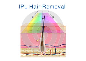 Using IPL light for hair removal on human skin.