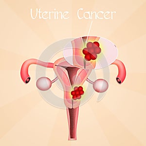 Uterine Cancer