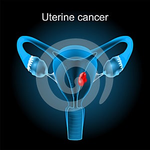 Uterine cancer. Cross section of a human uterus with Endometrial tumor