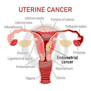 Uterine cancer. Diseases of the female reproductive system. Gynecology. Medical concept. Infographic banner.