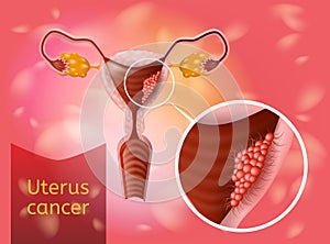 Uterine Cancer Realistic Vector Healthcare Concept