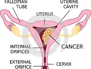 Uterine Cancer Vector Poster or Chart with Cancerous Tumor Cells on Endometrium Tissue of Uterus photo