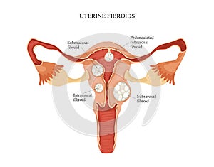 Uterine fibroid