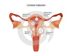 Uterine fibroid photo