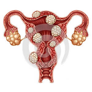 Uterine Fibroid photo