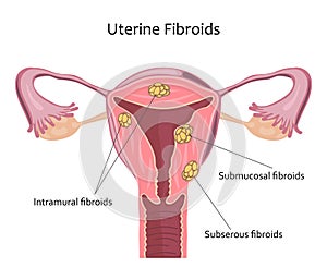 Uterine Fibroids Illustration