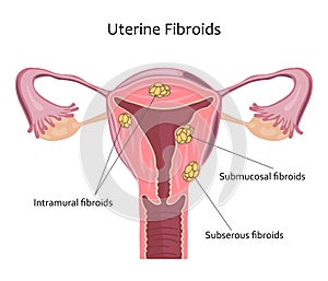Uterine Fibroids Illustration photo