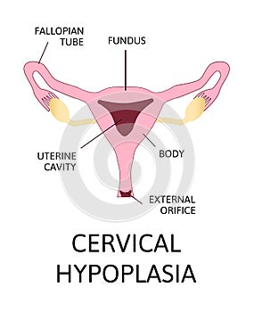 Uterine hypoplasia, naive uterus or infantile uterus