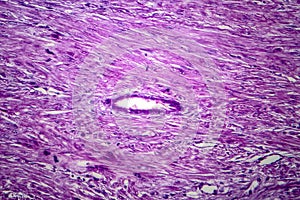 Uterine leiomyoma, light micrograph