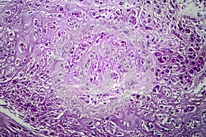 Uterine leiomyoma, light micrograph