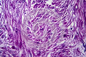Uterine leiomyoma, light micrograph
