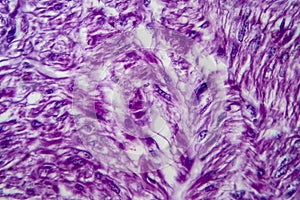 Uterine leiomyoma, light micrograph