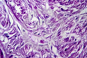 Uterine leiomyoma, light micrograph