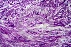 Uterine leiomyoma, light micrograph photo