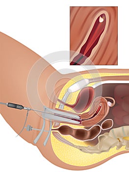 Uterine Polyps or Endometrial Polyps. Diagnostic Hysteroscopy. Procedure photo