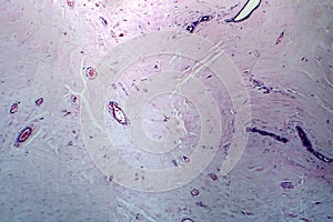 Uterus adenofibroma, light micrograph