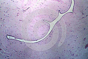 Uterus adenofibroma, light micrograph