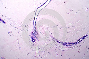 Uterus adenofibroma, light micrograph