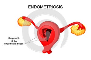 The uterus affected by endometriosis
