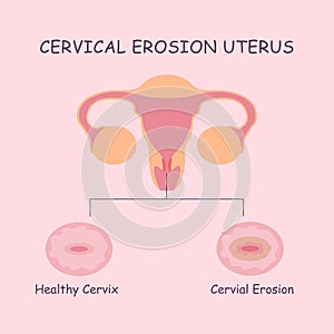 Uterus and cervical erosion