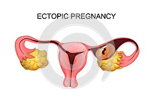 Uterus with ectopic pregnancy photo