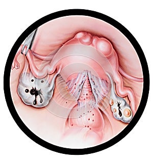 Uterus - Endometriosis