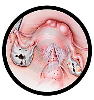 Uterus - Endometriosis photo