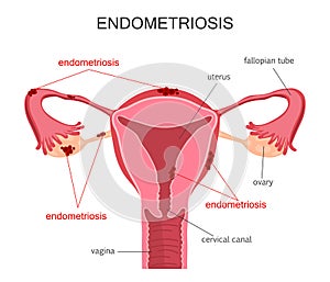 Uterus Endometriosis Diagram photo