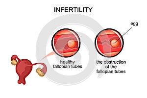 Uterus.infertility due to obstruction of the fallopian tubes photo