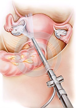 Uterus - Laparoscopy photo