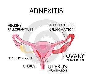 Uterus and ovaries scheme, adnexitis - infection and inflammation in the fallopian tube and ovary. Uterus inflammation