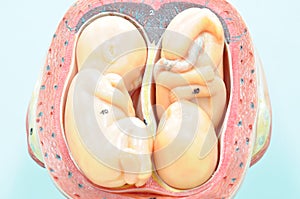 Uterus with twin fetus