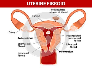 Uterus & types of fibroids photo