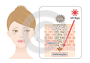 UV radiation induces dark spot on young woman’s face by melanin. Human skin cell. Beauty and health care concept