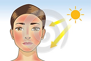 UV ray from sun made the redness appear on woman facial and neck skin.