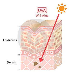 UVA damages to human skin. UVA resulting in winkles. Beauty and heath care concept