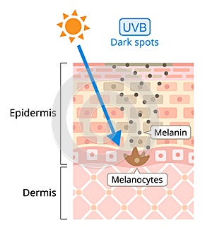 UVB damages to human skin. Ultraviolet B has a shorter wavelength. It is associated with dark spot. Beauty and heath care