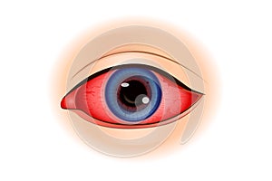 Uveitis symptoms or Eye Inflammation.