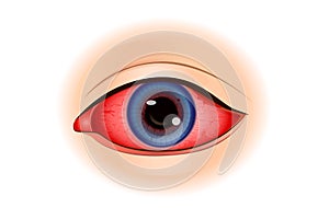 Uveitis symptoms or Eye Inflammation. photo