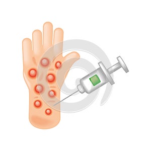 vaccination against monkeypox virus